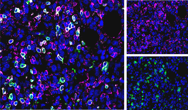 Abb. 1: CD3 (rosa), CD4 (grün) und DAPI (blau) Färbung im CT26-Tumor.